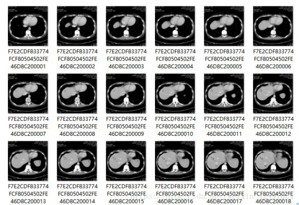 MicroDicom  viewer(Dicom格式看图软件)